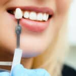 How To Finance Dental Implants